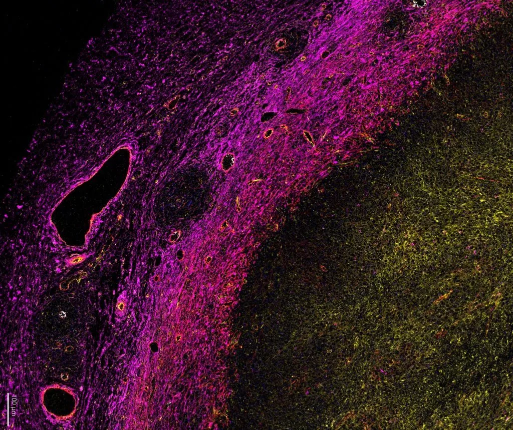 Multiplex immunofluorescence of a tumour section